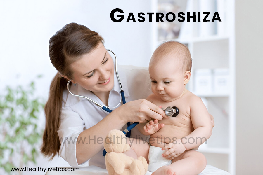 Gastroshiza: Understanding the Birth Defect and Its Impact
